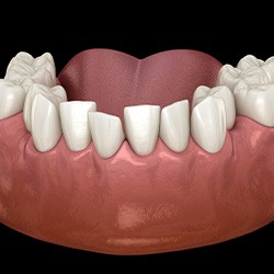 Illustration of crowded teeth
