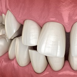 Illustration of gapped teeth