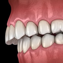 Illustration of an overbite