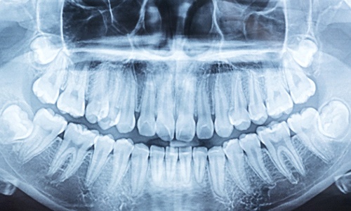 dental X-ray