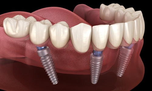 diagram of All-on-4 implants within the jawbone 