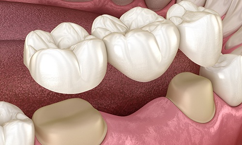 Digital illustration of a dental bridge in Braintree