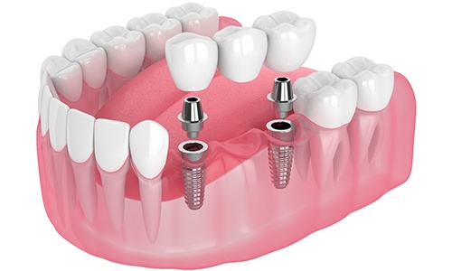 Digital illustration of an implant bridge in Braintree