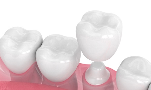 Diagram showing how CEREC same-day dental crowns in Braintree are placed