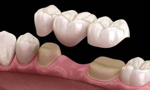 A digital image of a bottom arch of teeth with a dental bridge being placed over two prepped teeth and a vacated socket