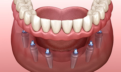 Illustration of implant dentures