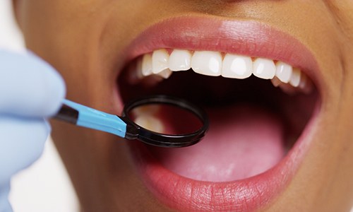 Closeup of Braintree dentist placing filling