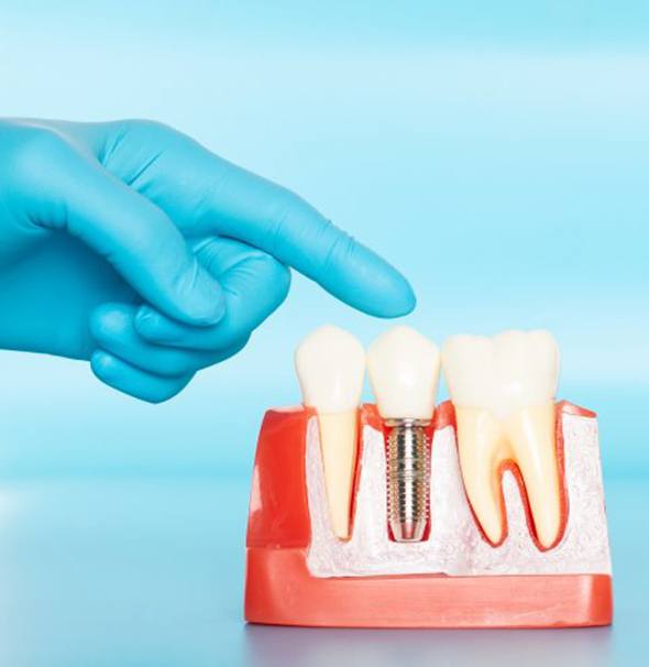 Dentist pointing to model of dental implants in Braintree