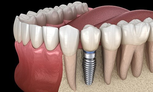 a closeup of a smile with missing teeth