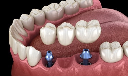 a graphic illustrating a restoration being placed