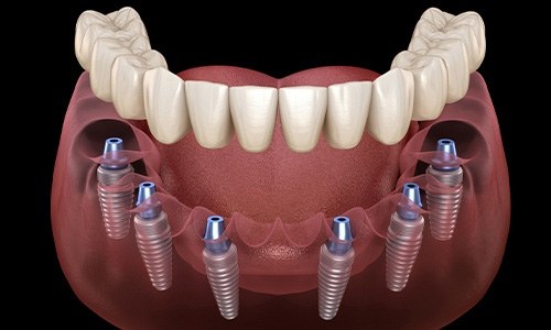 graphic illustrating a restoration being placed