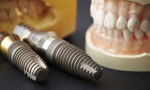 a closeup of dental implants