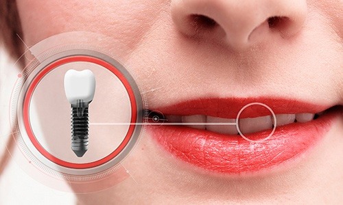 a graphic image illustrating dental implant placement