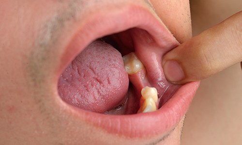 Closeup of smile with missing tooth