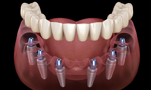 Animation of implant supported denture