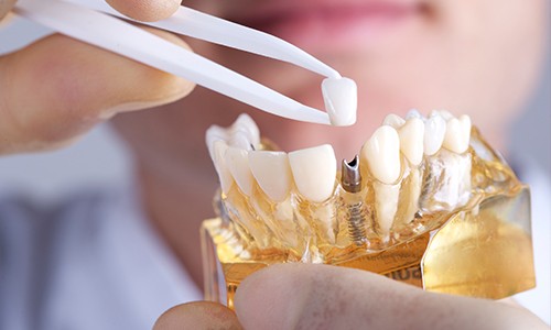 Model smile with implant supported fixed bridge