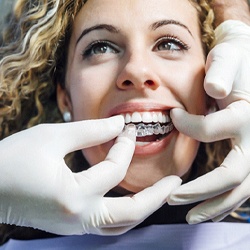 Invisalign dentist placing clear aligner in patient's mouth