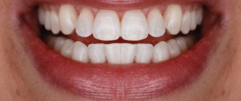 A beautiful smile after cosmetic work