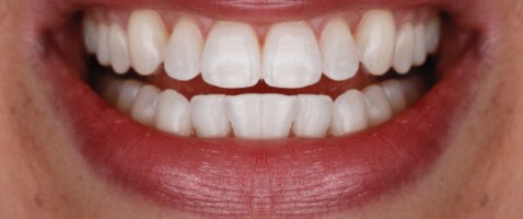A beautiful smile after cosmetic work