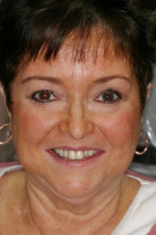 Older woman with yellowed teeth