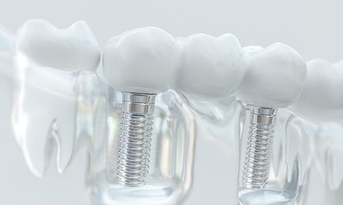 Model of implant-supported bridge treating tooth loss.