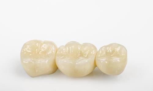 All-ceramic bridge for tooth loss.