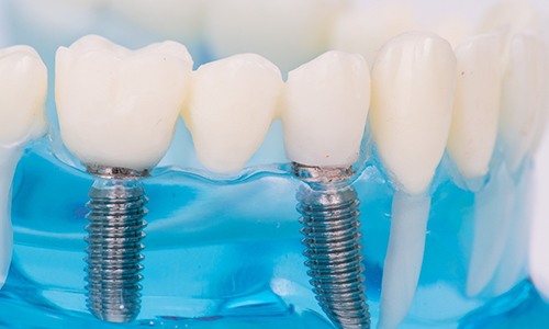 Implant-supported bridge for missing teeth.