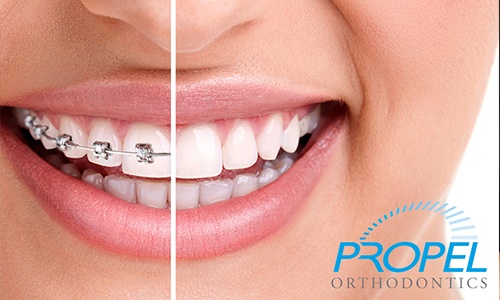 Closeup of smile before and after braces