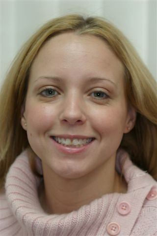 Woman's flawed teeth before veneers