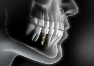 dental implant