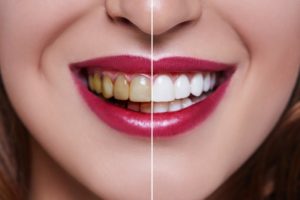 split picture of a smile before and after teeth whitening