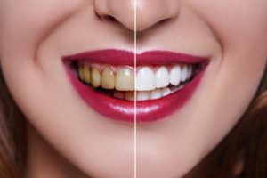 split picture of a smile before and after teeth whitening 