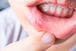 Closeup of canker sore mouth sores