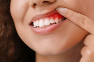 a patient pointing toward their gums 