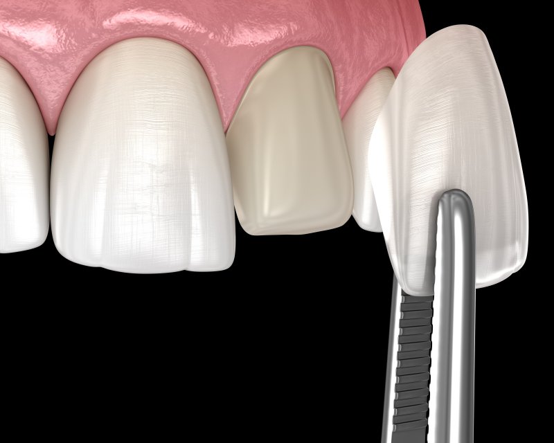 digital image of veneer